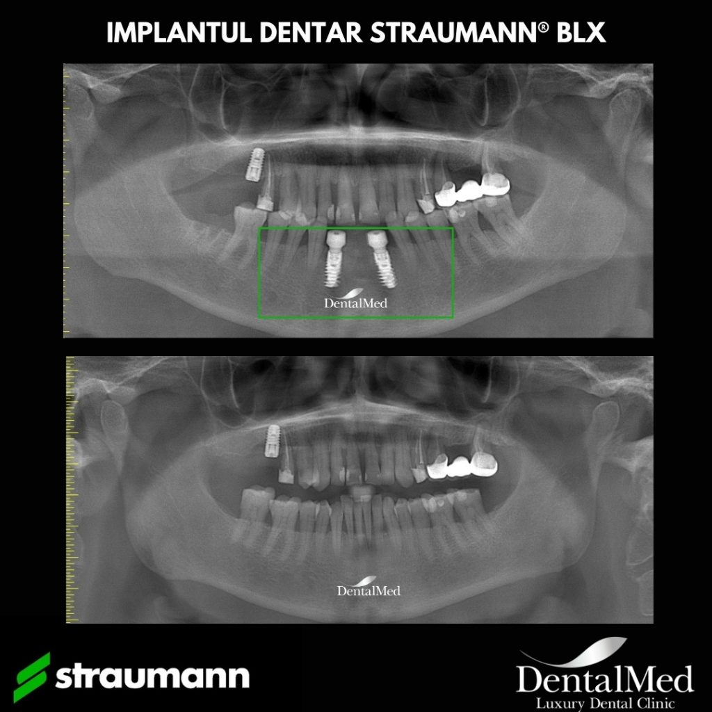 DentalMed RX before and after STRAUMANN BLX Implant dentar STRAUMANN BLX®