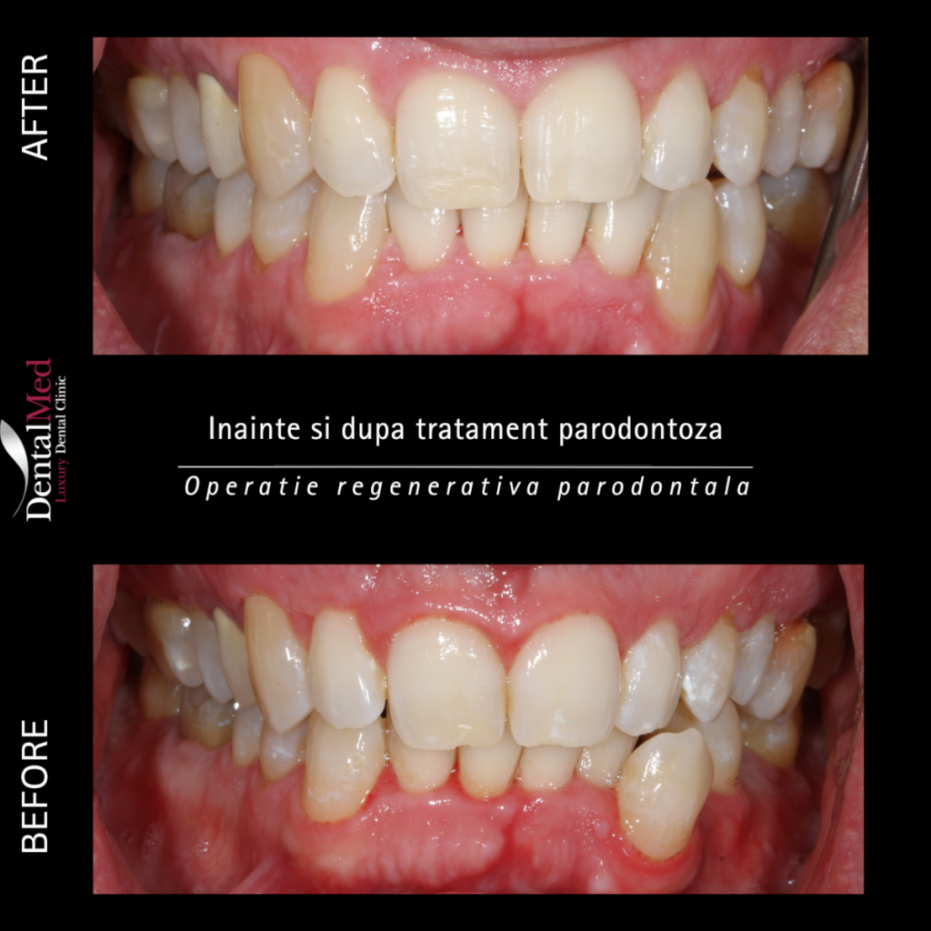 Before & After periodontics treatment