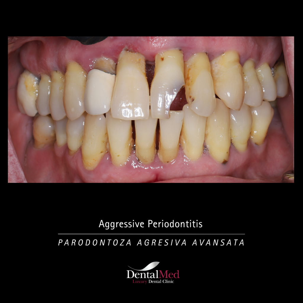 Parodontoza Agresiva Parodontoza Tratament in Bucuresti