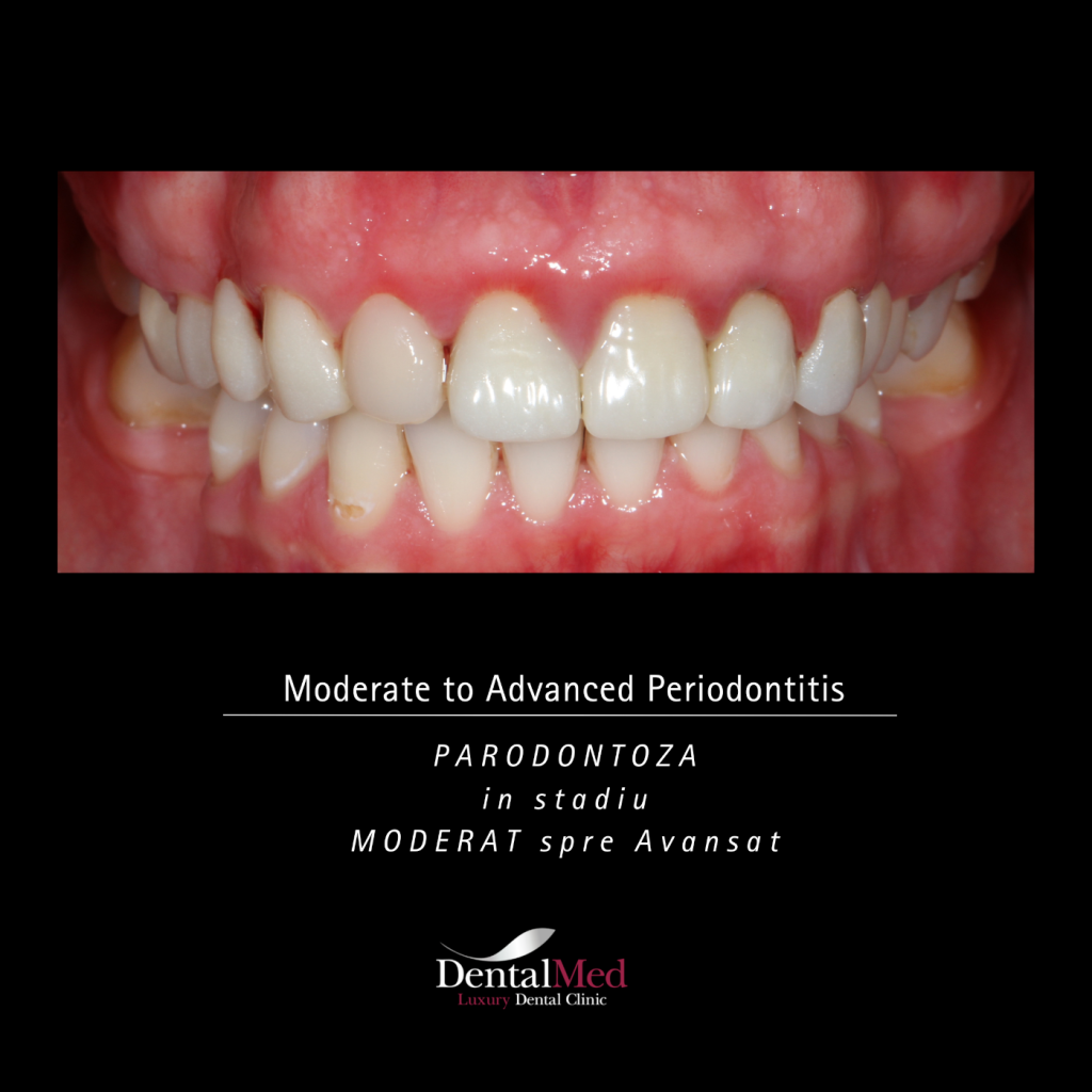 Parodontoza Moderate to Advanced Parodontoza Tratament in Bucuresti