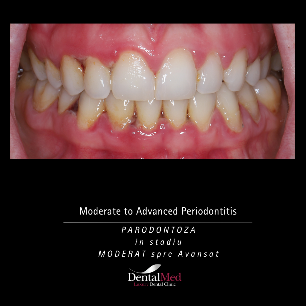 Parodontoza Moderate to Advanced Parodontoza Tratament in Bucuresti