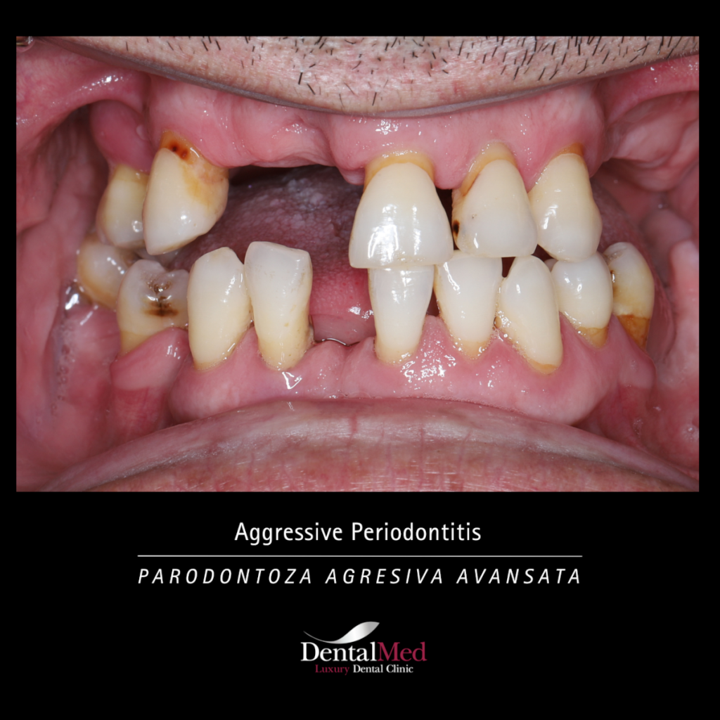 parodontoza agresiva avansata Parodontoza Tratament in Bucuresti