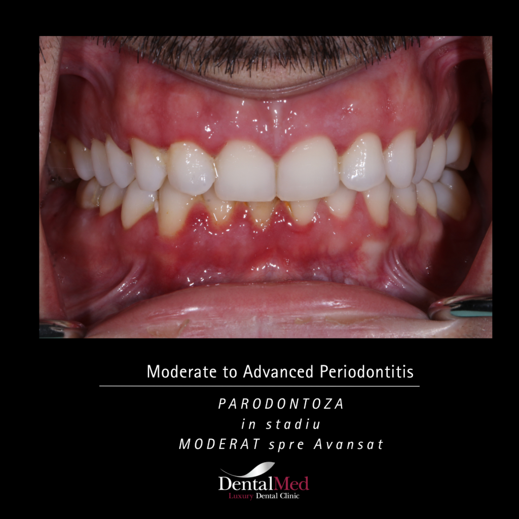 parodontoza moderata Parodontoza Tratament in Bucuresti