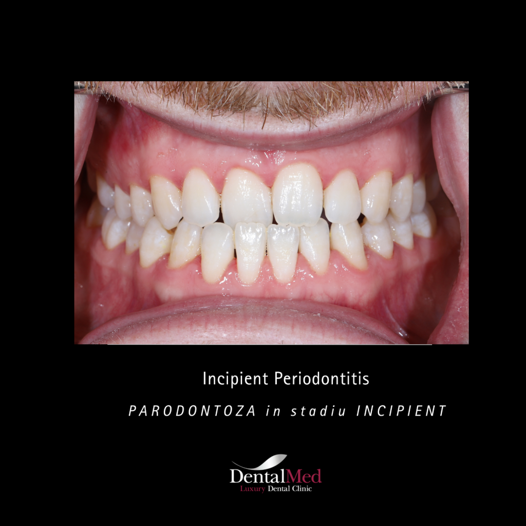 parodontoza stadiu incipient Parodontoza Tratament in Bucuresti