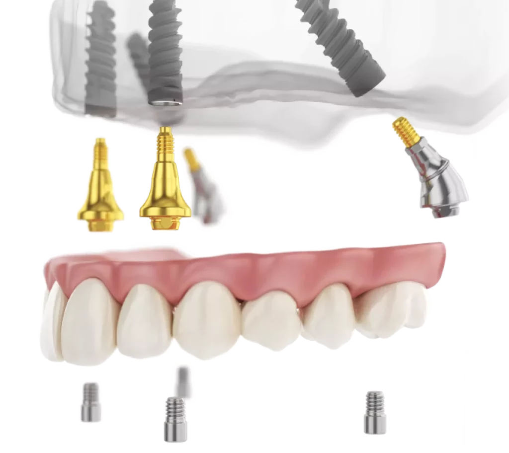 implant dentar alpha bio