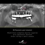 vitamina d implant dentar