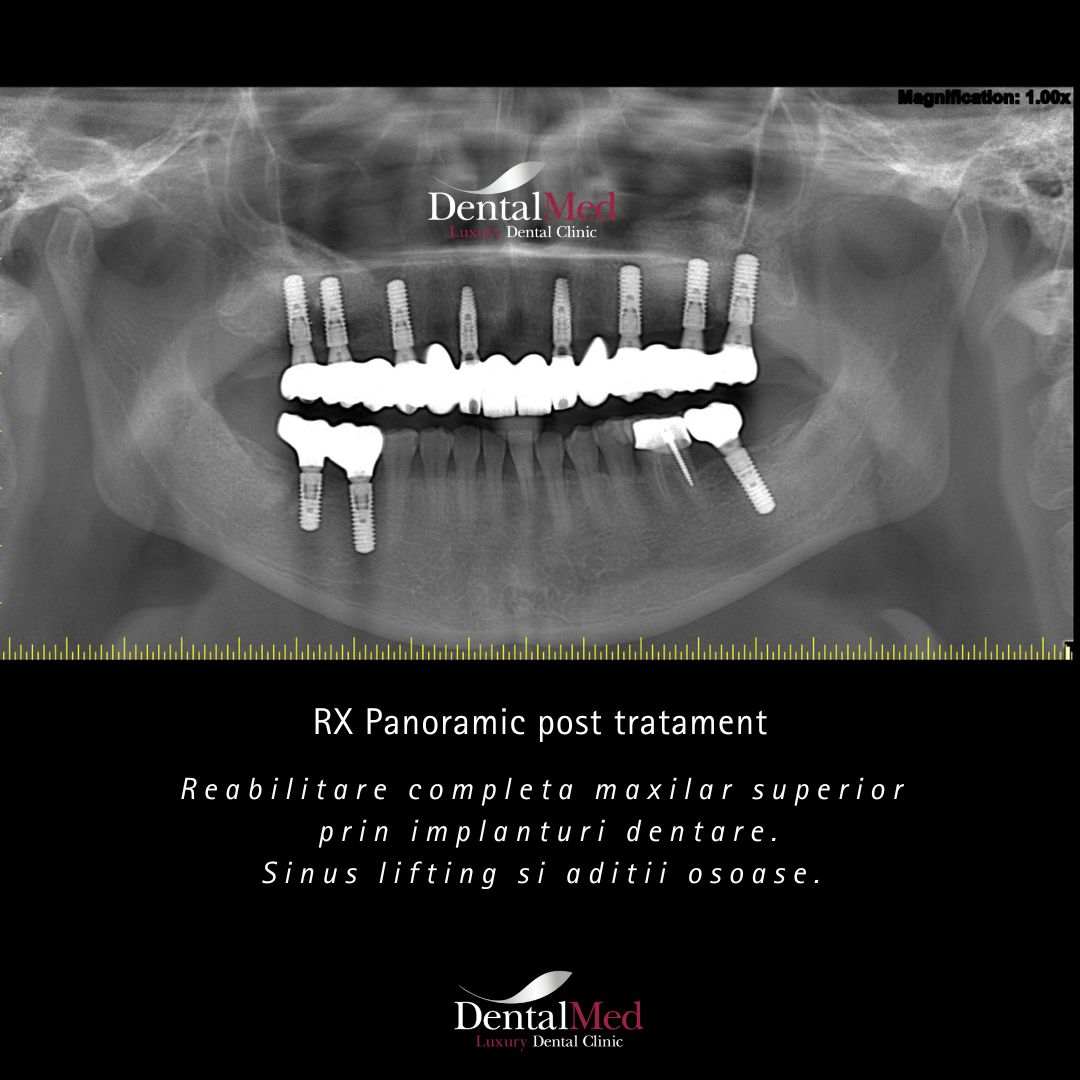 vitamina d implant dentar