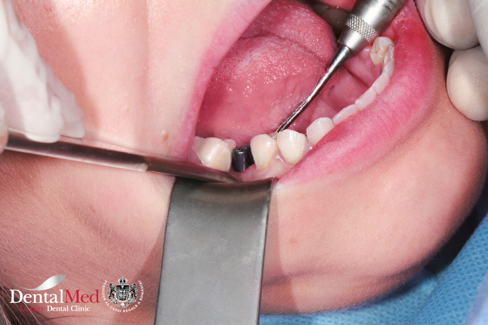 IMG 0612 edit Implant dentar Bucuresti premium